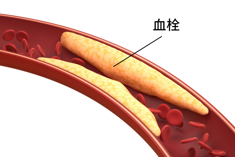 血栓“大户”被揪出，是肥肉的10倍！医生：经常吃，血管或扛不住