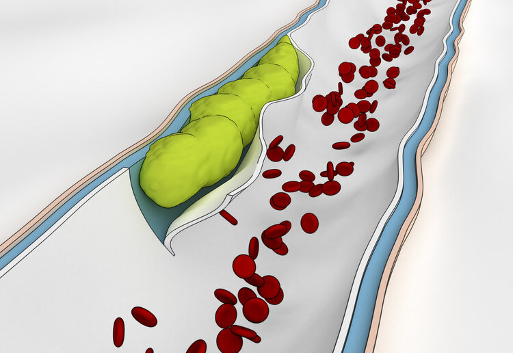 血栓“大户”被揪出，是肥肉的10倍！医生：经常吃，血管或扛不住